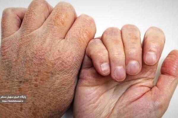 شیوع جذام در کشور کذب است/ کمتر از ۱۰ مورد ابتلا در سال